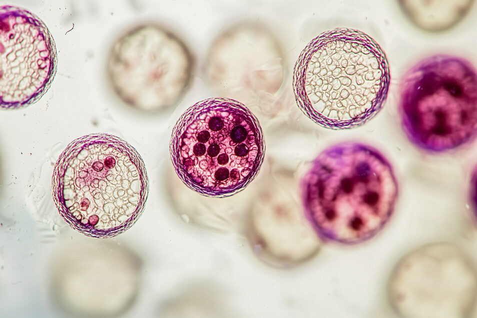 Hematuria